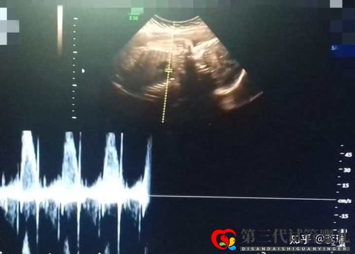 我终于怀上了!辛酸三代试管经历!大家接好孕!(图4) 我终于怀上了!辛酸三代试管经历!大家接好孕!(图4)