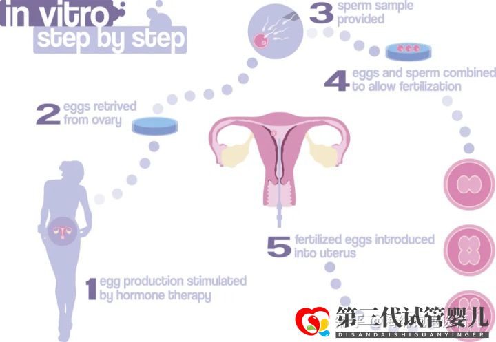 试管婴儿1代、2代、3代、4代哪个最好真实操作过...(图3)