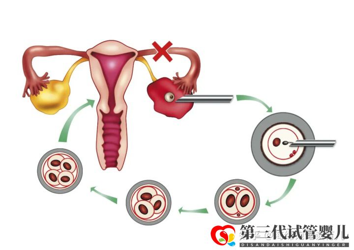 试管婴儿1代、2代、3代、4代哪个最好真实操作过...(图7)