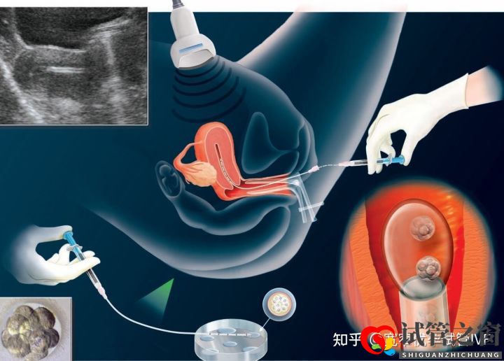 重庆哪里可以做试管婴儿供卵供卵需要多少钱(图4)