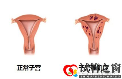 33岁子宫畸形多年未孕,如何提高试管成功率(图1) 33岁子宫畸形多年未孕,如何提高试管成功率(图1)