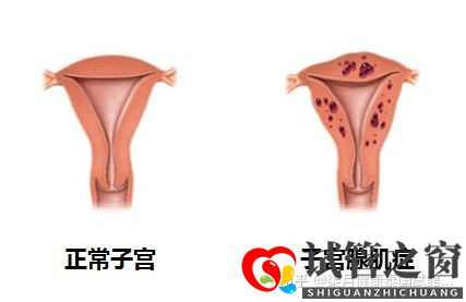 33岁子宫畸形多年未孕,如何提高试管成功率(图1)