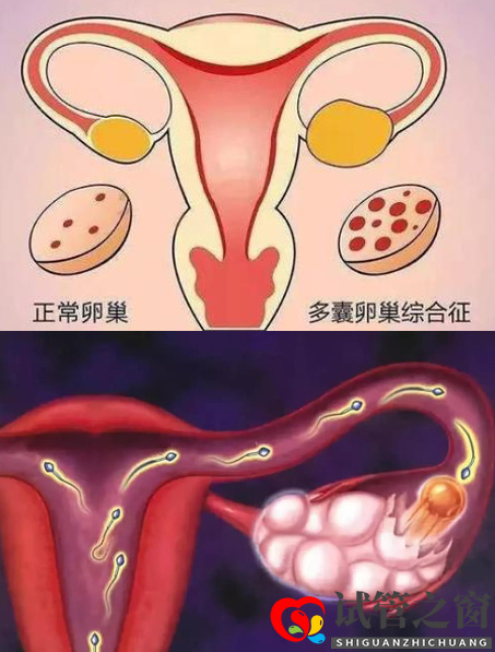 多囊卵巢综合症做试管婴儿要注意什么(图1)
