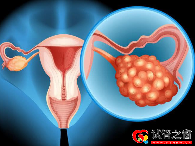 多囊可以进行治疗怀孕