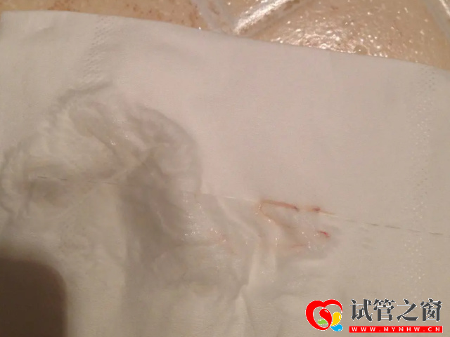 排卵期女性白带量会增加