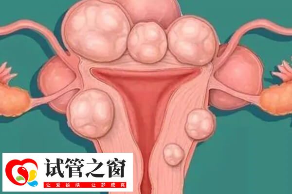 子宫肌瘤试管前可以进行治疗