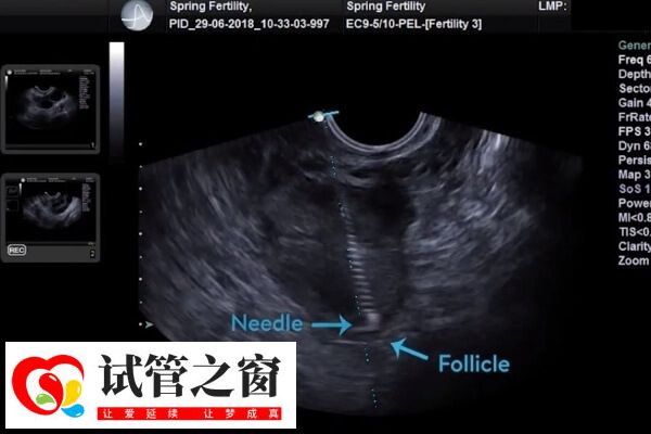 取卵后腹水要注意及时就医
