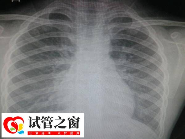 做试管拍胸片是常规体检项目之一