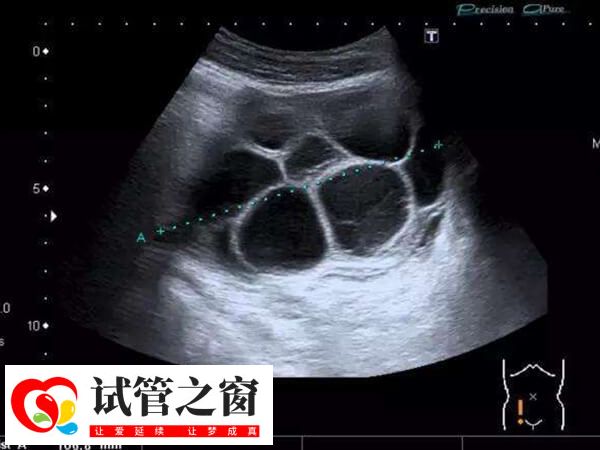 取卵过度会造成卵巢过度刺激症