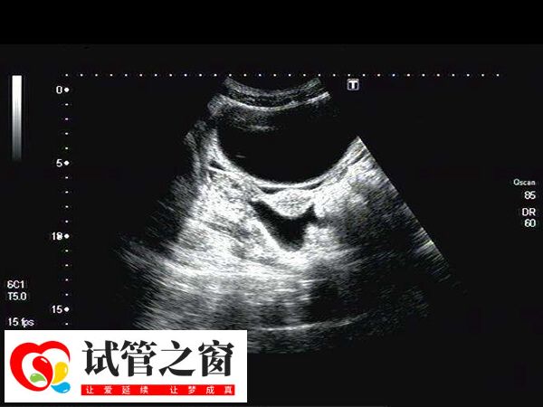 囊胚移植后会开始在子宫内漂浮